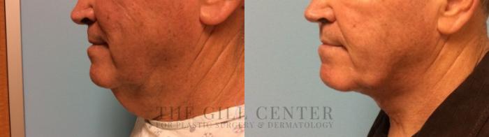  Male T-Z-Plasty Case 505 Before & After Left Side | The Woodlands, TX | The Gill Center for Plastic Surgery and Dermatology