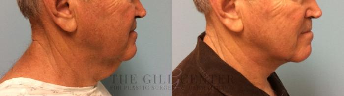  Male T-Z-Plasty Case 505 Before & After Right Side | The Woodlands, TX | The Gill Center for Plastic Surgery and Dermatology