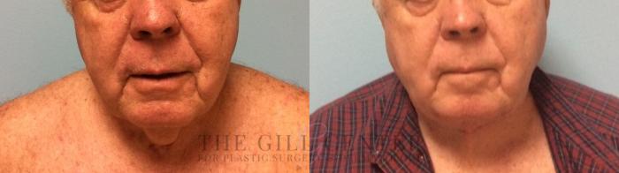  Male T-Z-Plasty Case 506 Before & After Front | The Woodlands, TX | The Gill Center for Plastic Surgery and Dermatology