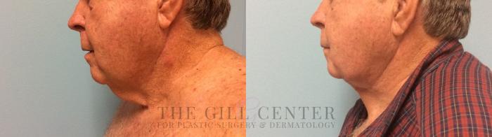  Male T-Z-Plasty Case 506 Before & After Left Side | The Woodlands, TX | The Gill Center for Plastic Surgery and Dermatology