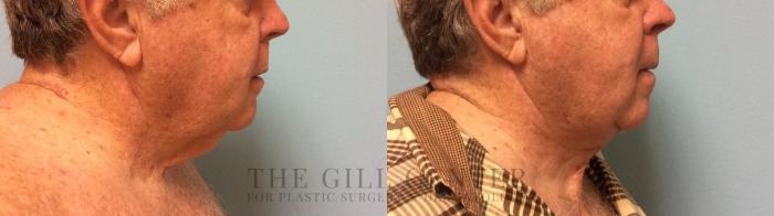  Male T-Z-Plasty Case 506 Before & After Right Side | The Woodlands, TX | The Gill Center for Plastic Surgery and Dermatology