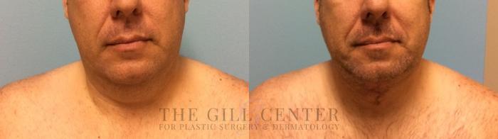 Male T-Z-Plasty Case 507 Before & After Front | The Woodlands, TX | The Gill Center for Plastic Surgery and Dermatology
