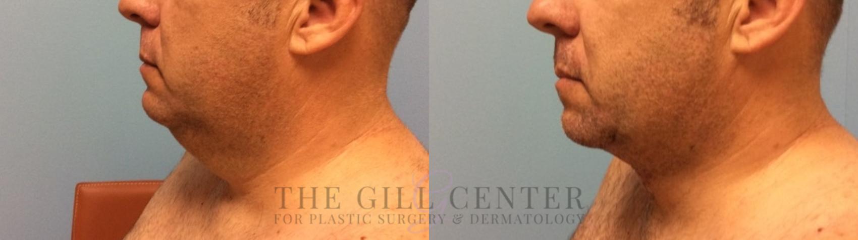  Male T-Z-Plasty Case 507 Before & After Left Side | The Woodlands, TX | The Gill Center for Plastic Surgery and Dermatology