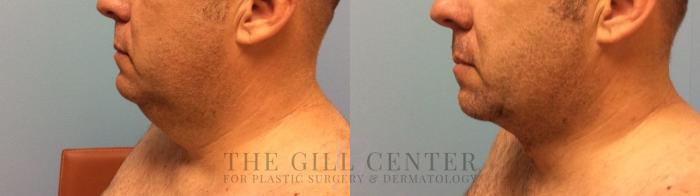  Male T-Z-Plasty Case 507 Before & After Left Side | The Woodlands, TX | The Gill Center for Plastic Surgery and Dermatology