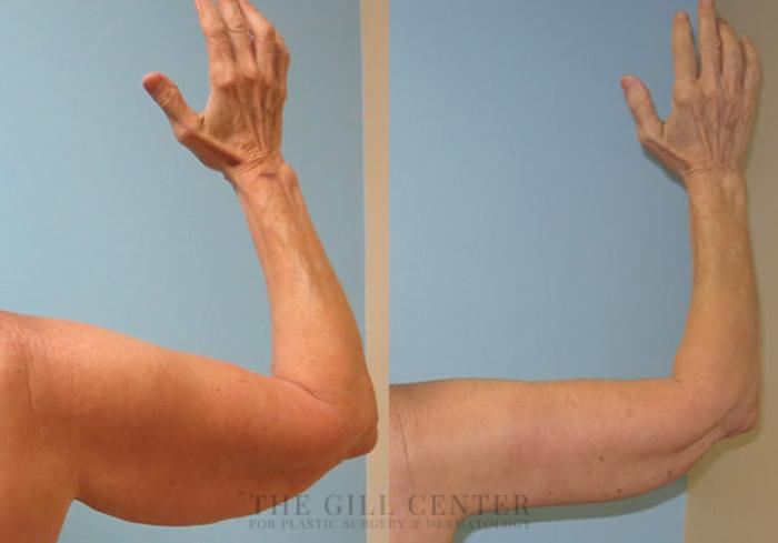 Arm Lift Case 10 Before & After Back | The Woodlands, TX | The Gill Center for Plastic Surgery and Dermatology