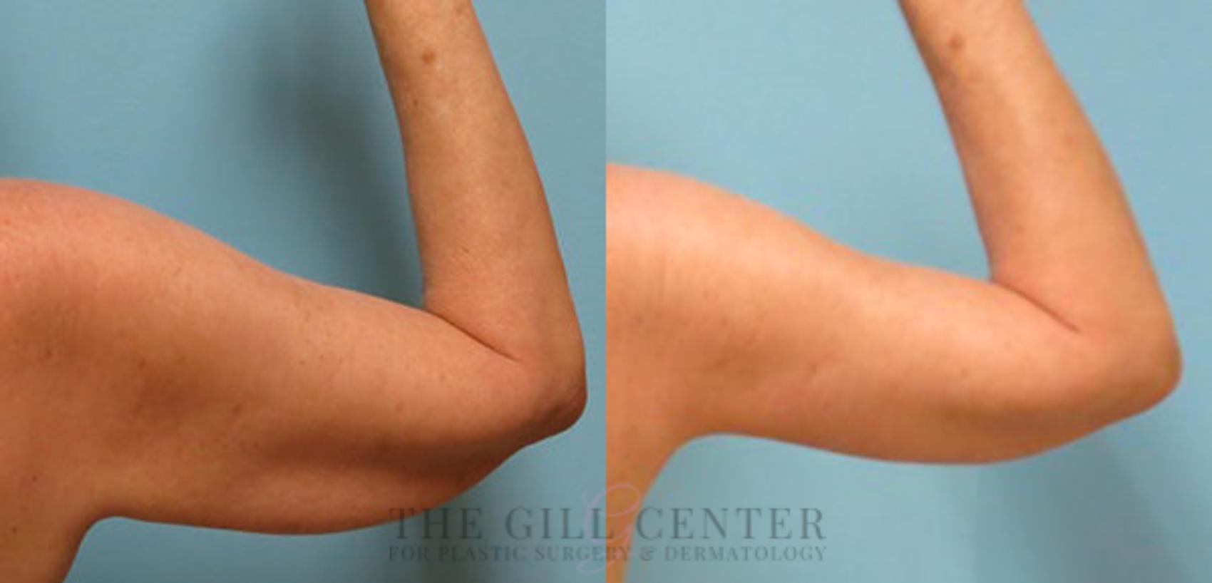 Arm Lift Case 11 Before & After Back | The Woodlands, TX | The Gill Center for Plastic Surgery and Dermatology
