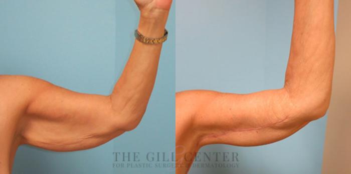 Arm Lift Case 13 Before & After Front | The Woodlands, TX | The Gill Center for Plastic Surgery and Dermatology