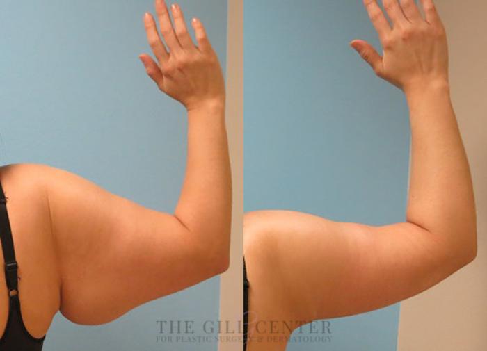 Arm Lift Case 14 Before & After Back | The Woodlands, TX | The Gill Center for Plastic Surgery and Dermatology