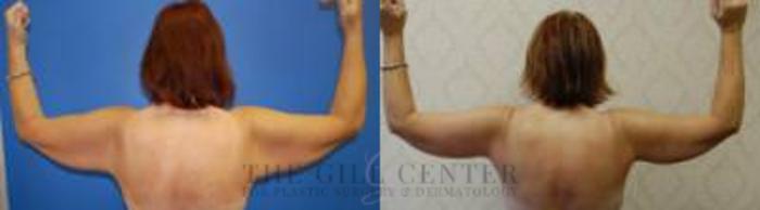 Arm Lift Case 15 Before & After Back | The Woodlands, TX | The Gill Center for Plastic Surgery and Dermatology
