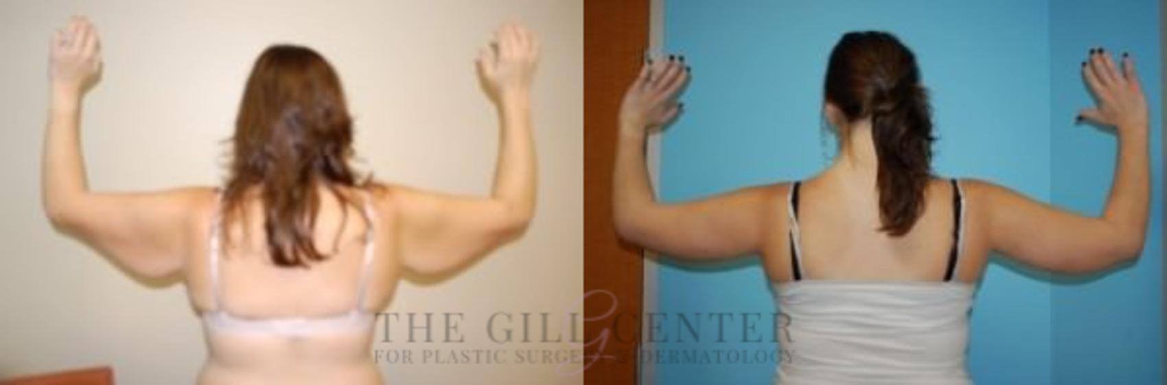 Arm Lift Case 16 Before & After Back | The Woodlands, TX | The Gill Center for Plastic Surgery and Dermatology
