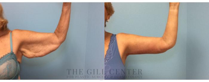 Arm Lift Case 4 Before & After Front | The Woodlands, TX | The Gill Center for Plastic Surgery and Dermatology