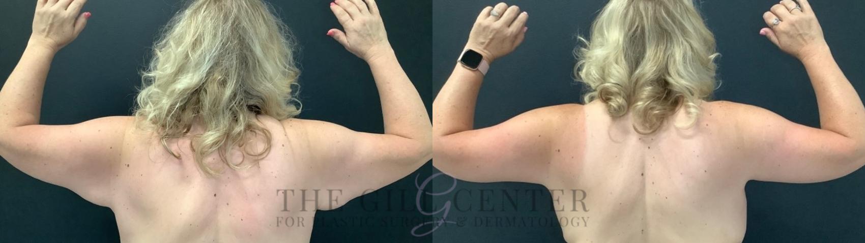 Arm Lift Case 647 Before & After Back | The Woodlands, TX | The Gill Center for Plastic Surgery and Dermatology