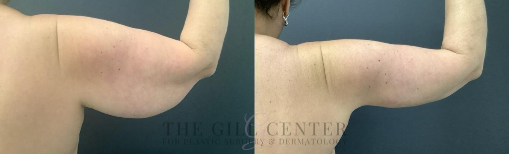 Arm Lift Case 677 Before & After Right Arm | The Woodlands, TX | The Gill Center for Plastic Surgery and Dermatology