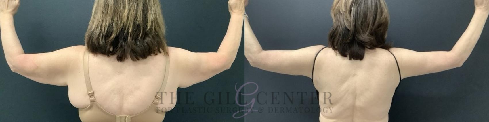 Arm Lift Case 678 Before & After Back | The Woodlands, TX | The Gill Center for Plastic Surgery and Dermatology