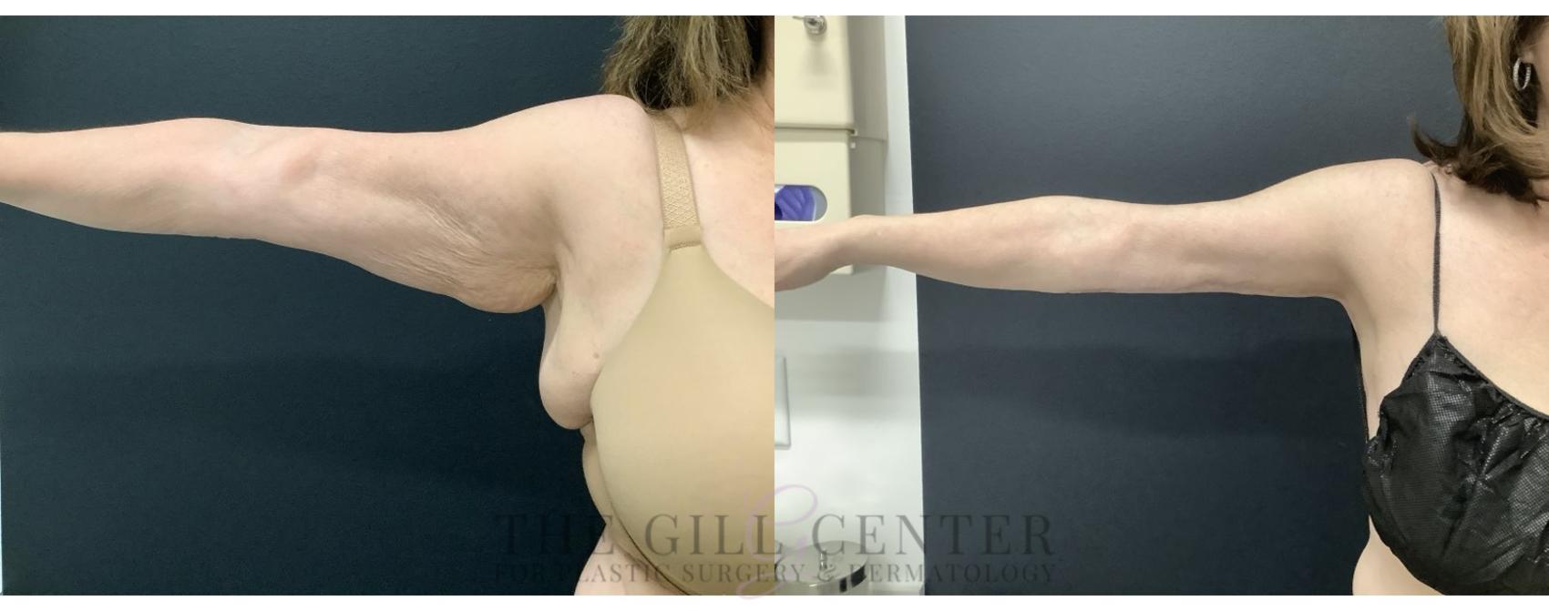 Arm Lift Case 678 Before & After Left Side | The Woodlands, TX | The Gill Center for Plastic Surgery and Dermatology