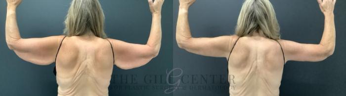 Arm Lift Case 685 Before & After Back | The Woodlands, TX | The Gill Center for Plastic Surgery and Dermatology