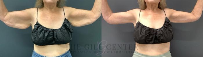 Arm Lift Case 685 Before & After Front | The Woodlands, TX | The Gill Center for Plastic Surgery and Dermatology