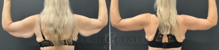 Arm Lift Case 733 Before & After Back | The Woodlands, TX | The Gill Center for Plastic Surgery and Dermatology