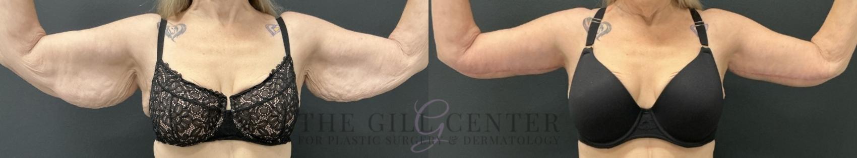 Arm Lift Case 733 Before & After Front | The Woodlands, TX | The Gill Center for Plastic Surgery and Dermatology