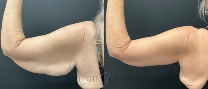 Arm Lift Case 733 Before & After Left side (back)  | The Woodlands, TX | The Gill Center for Plastic Surgery and Dermatology