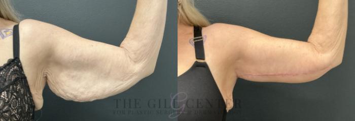 Arm Lift Case 733 Before & After Left Side | The Woodlands, TX | The Gill Center for Plastic Surgery and Dermatology