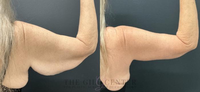 Arm Lift Case 733 Before & After Right side (back)  | The Woodlands, TX | The Gill Center for Plastic Surgery and Dermatology