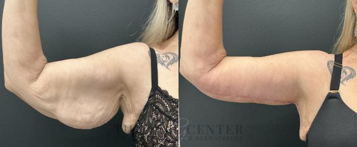 Arm Lift Case 733 Before & After Right Side | The Woodlands, TX | The Gill Center for Plastic Surgery and Dermatology