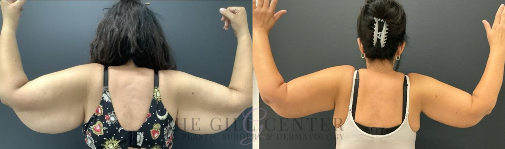 Arm Lift Case 741 Before & After Back | The Woodlands, TX | The Gill Center for Plastic Surgery and Dermatology