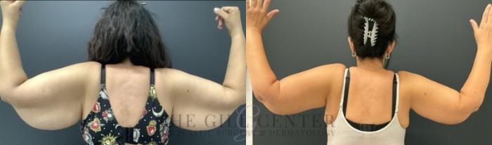 Arm Lift Case 741 Before & After Back | The Woodlands, TX | The Gill Center for Plastic Surgery and Dermatology
