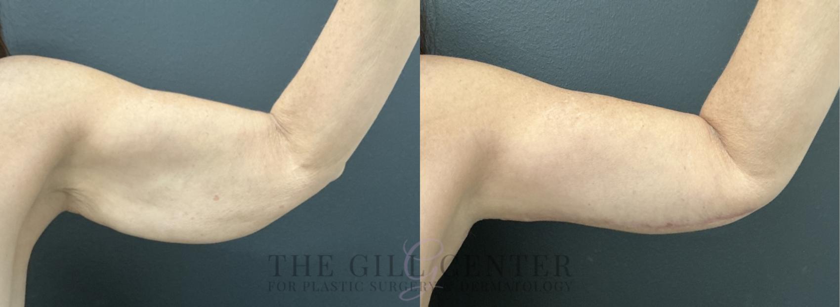 Arm Lift Case 777 Before & After Anterior left arm  | The Woodlands, TX | The Gill Center for Plastic Surgery and Dermatology