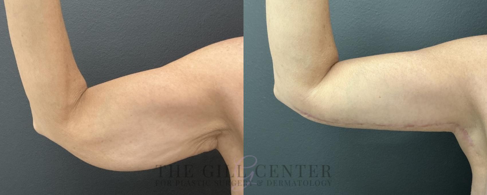 Arm Lift Case 777 Before & After Anterior right arm  | The Woodlands, TX | The Gill Center for Plastic Surgery and Dermatology