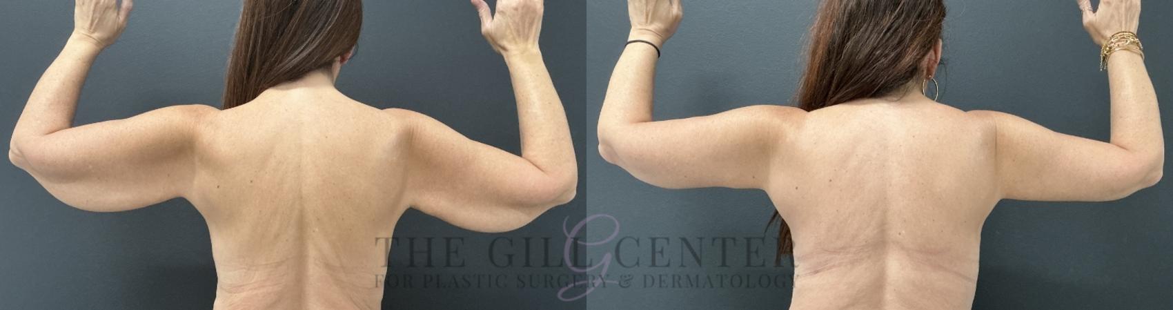 Arm Lift Case 777 Before & After Back | The Woodlands, TX | The Gill Center for Plastic Surgery and Dermatology
