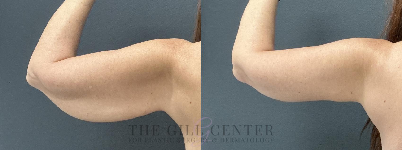 Arm Lift Case 777 Before & After Posterior left arm | The Woodlands, TX | The Gill Center for Plastic Surgery and Dermatology