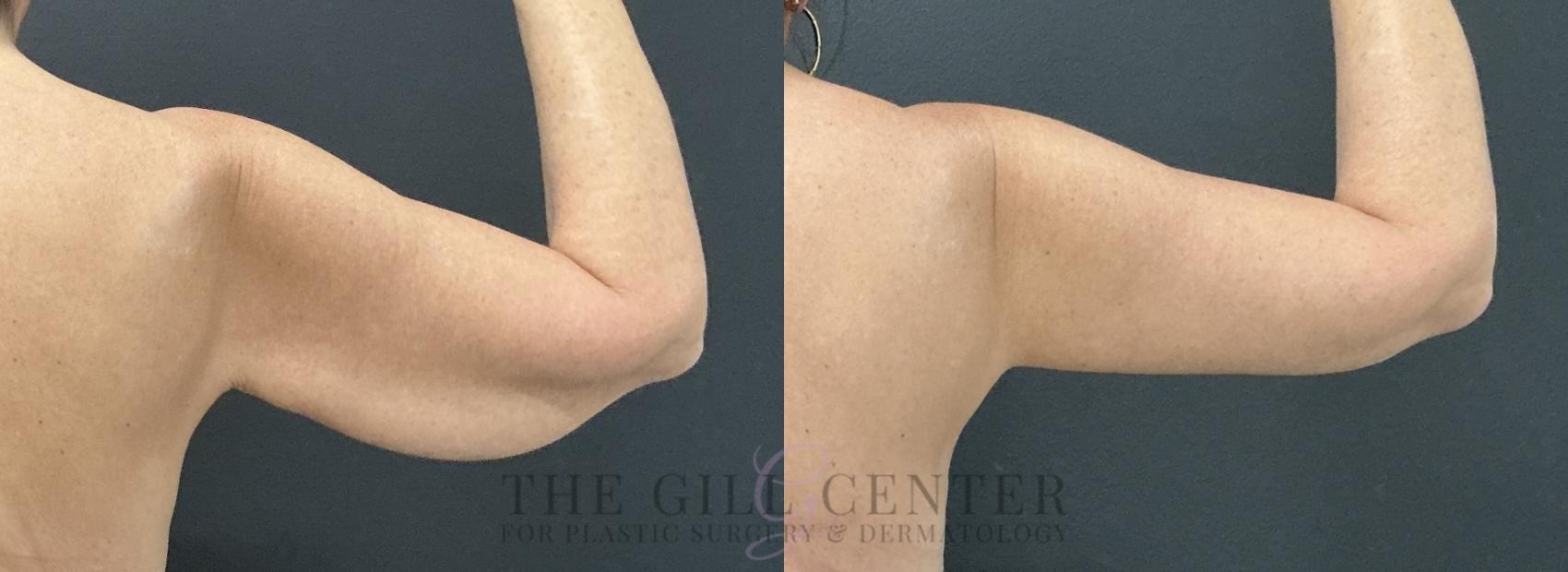 Arm Lift Case 777 Before & After Posterior right arm | The Woodlands, TX | The Gill Center for Plastic Surgery and Dermatology
