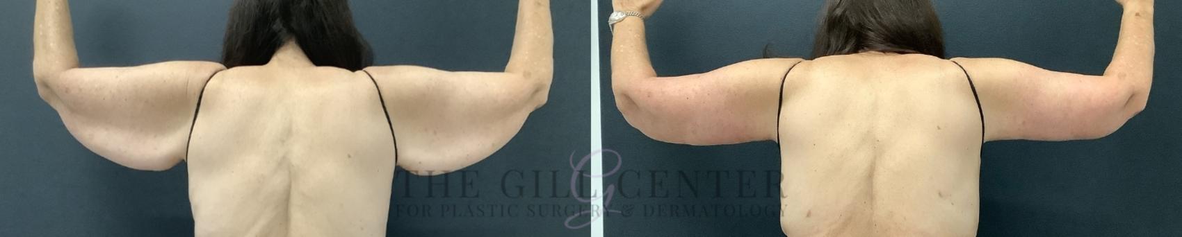 Arm Lift Case 799 Before & After Back | The Woodlands, TX | The Gill Center for Plastic Surgery and Dermatology