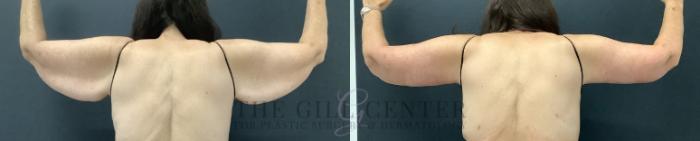 Arm Lift Case 799 Before & After Back | The Woodlands, TX | The Gill Center for Plastic Surgery and Dermatology