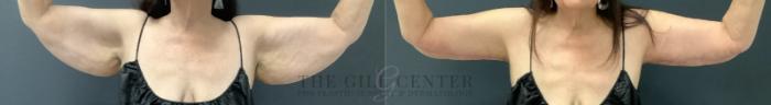 Arm Lift Case 799 Before & After Front | The Woodlands, TX | The Gill Center for Plastic Surgery and Dermatology