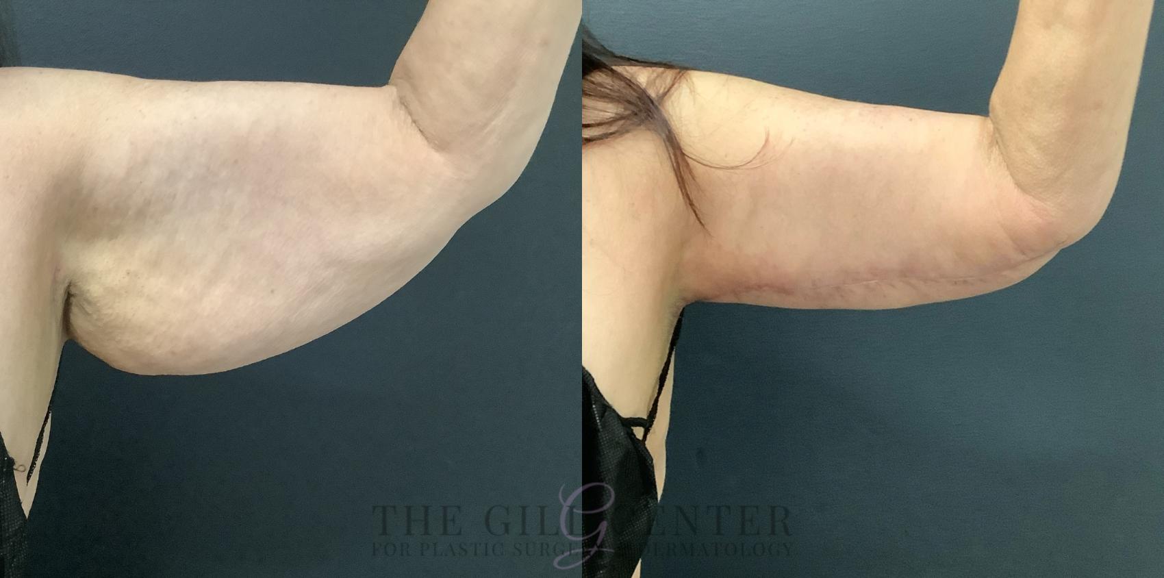 Arm Lift Case 799 Before & After Left anterior arm | The Woodlands, TX | The Gill Center for Plastic Surgery and Dermatology