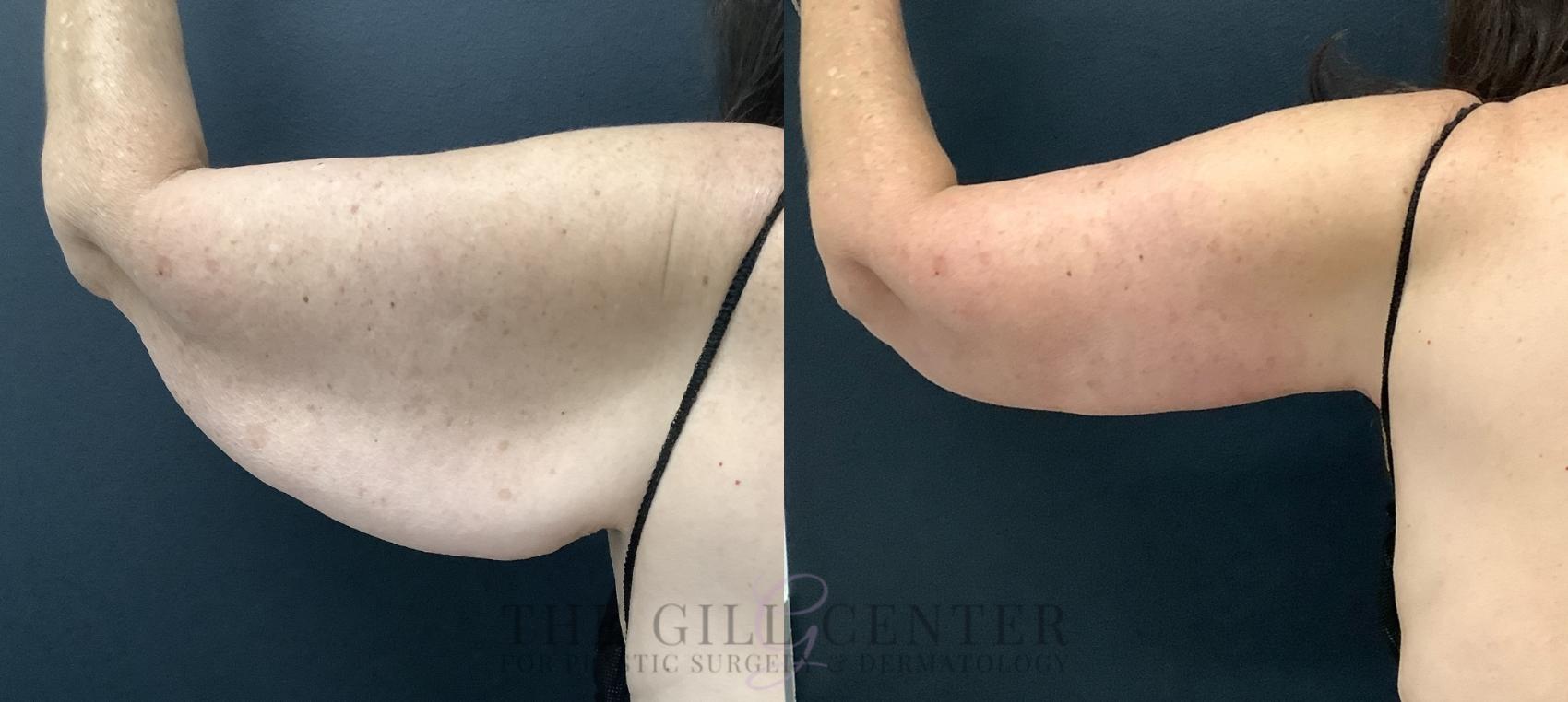 Arm Lift Case 799 Before & After Left posterior arm  | The Woodlands, TX | The Gill Center for Plastic Surgery and Dermatology