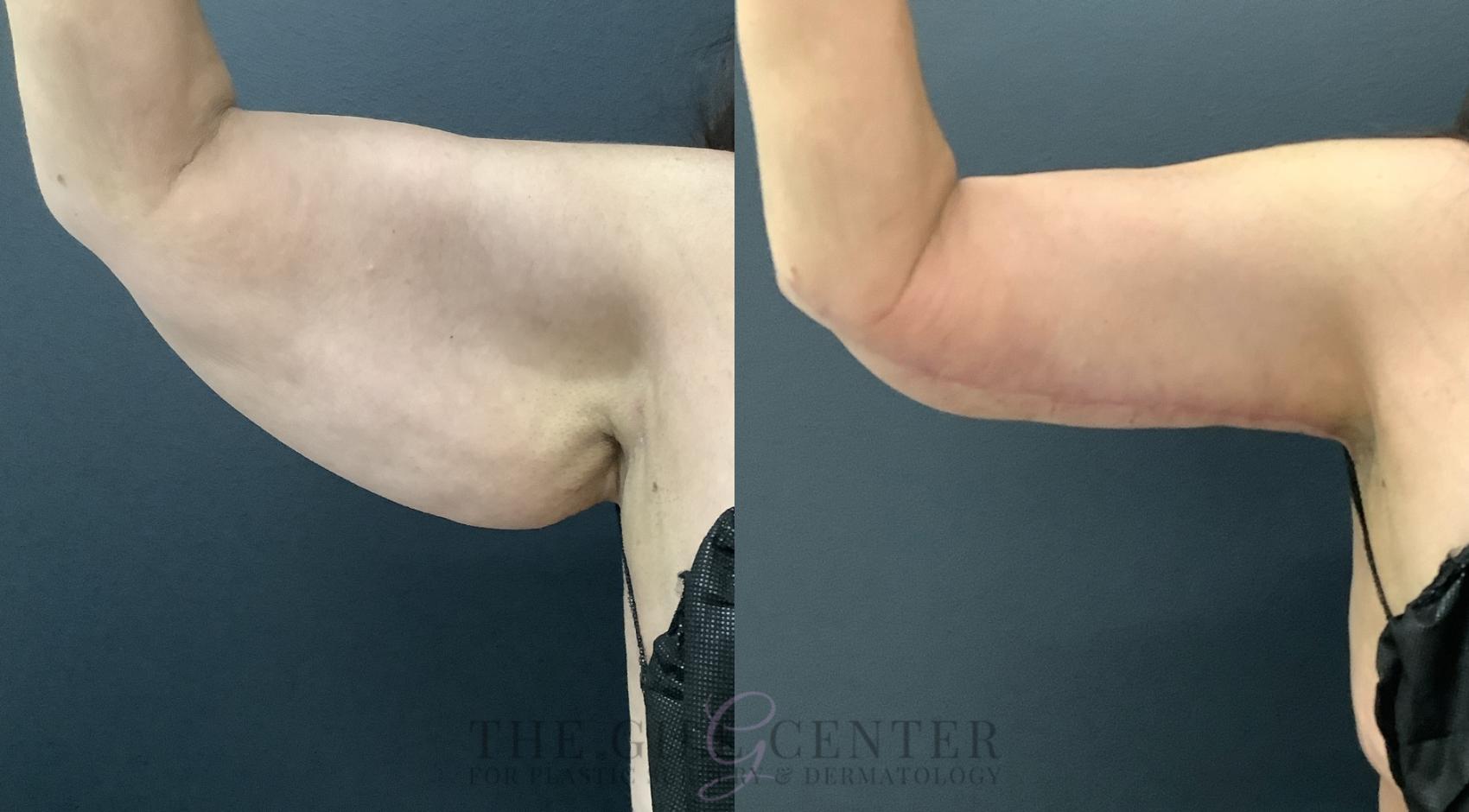 Arm Lift Case 799 Before & After Right anterior arm | The Woodlands, TX | The Gill Center for Plastic Surgery and Dermatology