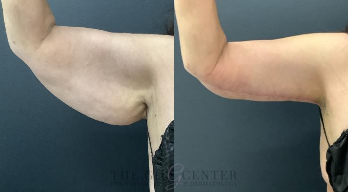 Arm Lift Case 799 Before & After Right anterior arm | The Woodlands, TX | The Gill Center for Plastic Surgery and Dermatology