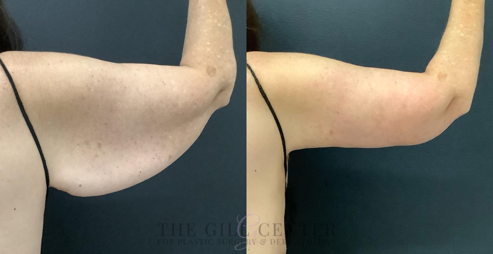 Arm Lift Case 799 Before & After Right posterior arm | The Woodlands, TX | The Gill Center for Plastic Surgery and Dermatology