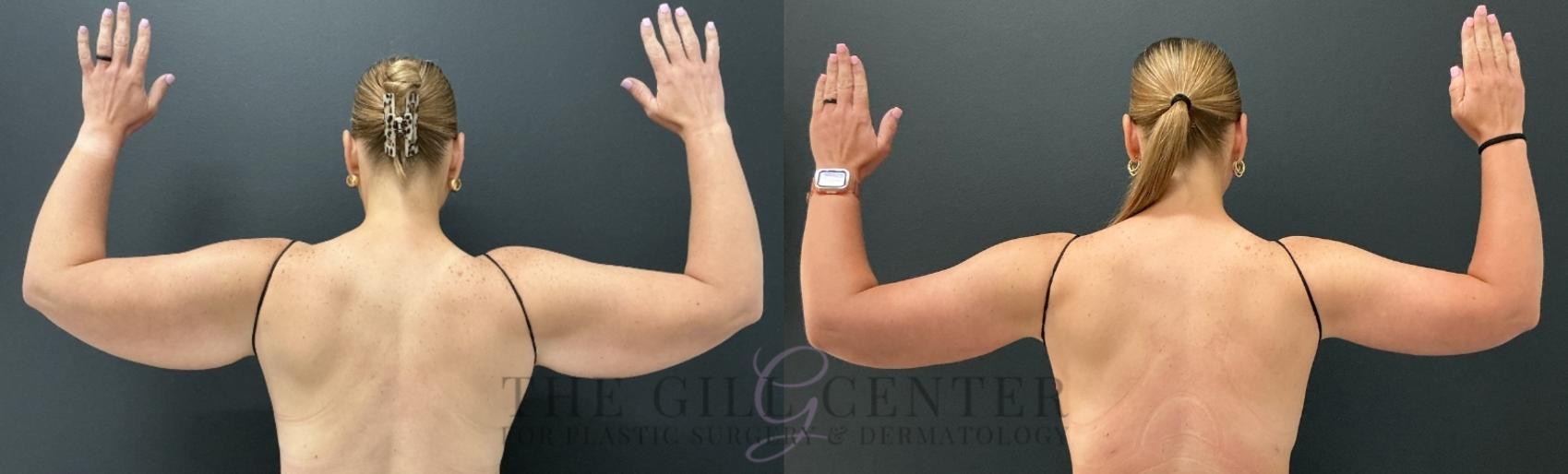 Arm Lift Case 808 Before & After Back | The Woodlands, TX | The Gill Center for Plastic Surgery and Dermatology