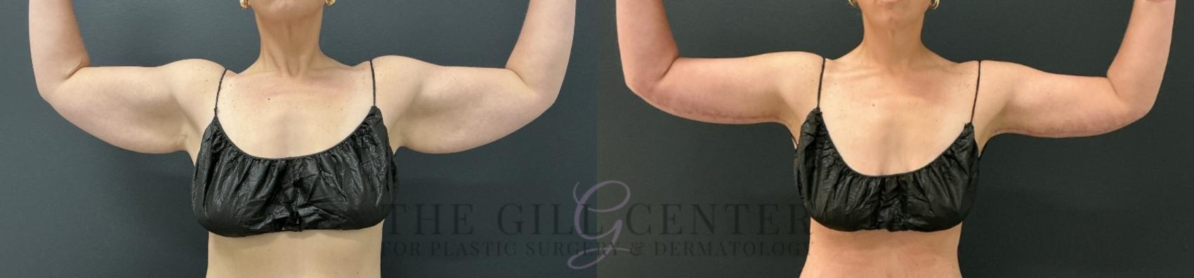 Arm Lift Case 808 Before & After Front | The Woodlands, TX | The Gill Center for Plastic Surgery and Dermatology