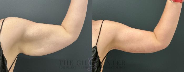 Arm Lift Case 808 Before & After Left anterior arm | The Woodlands, TX | The Gill Center for Plastic Surgery and Dermatology