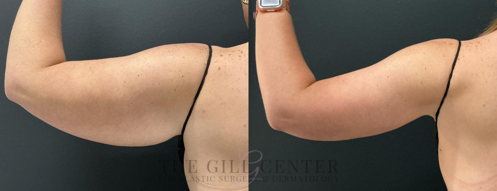 Arm Lift Case 808 Before & After Left posterior arm | The Woodlands, TX | The Gill Center for Plastic Surgery and Dermatology