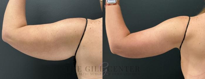 Arm Lift Case 808 Before & After Left posterior arm | The Woodlands, TX | The Gill Center for Plastic Surgery and Dermatology
