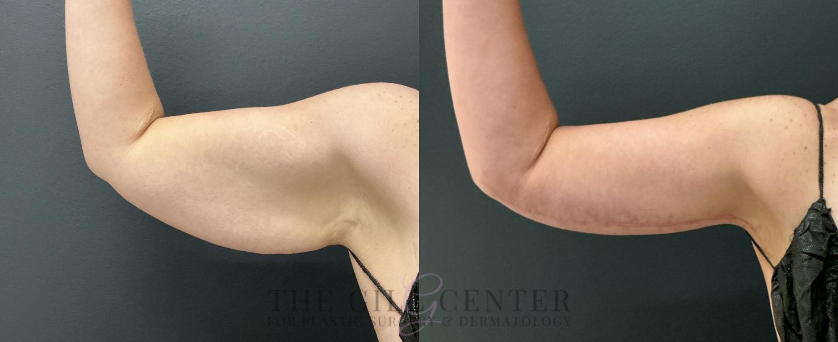 Arm Lift Case 808 Before & After Right anterior arm | The Woodlands, TX | The Gill Center for Plastic Surgery and Dermatology