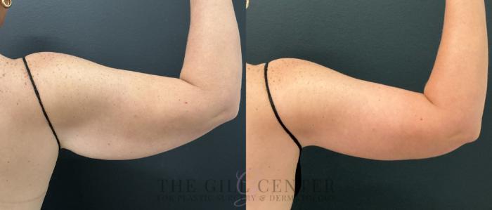 Arm Lift Case 808 Before & After Right posterior arm | The Woodlands, TX | The Gill Center for Plastic Surgery and Dermatology