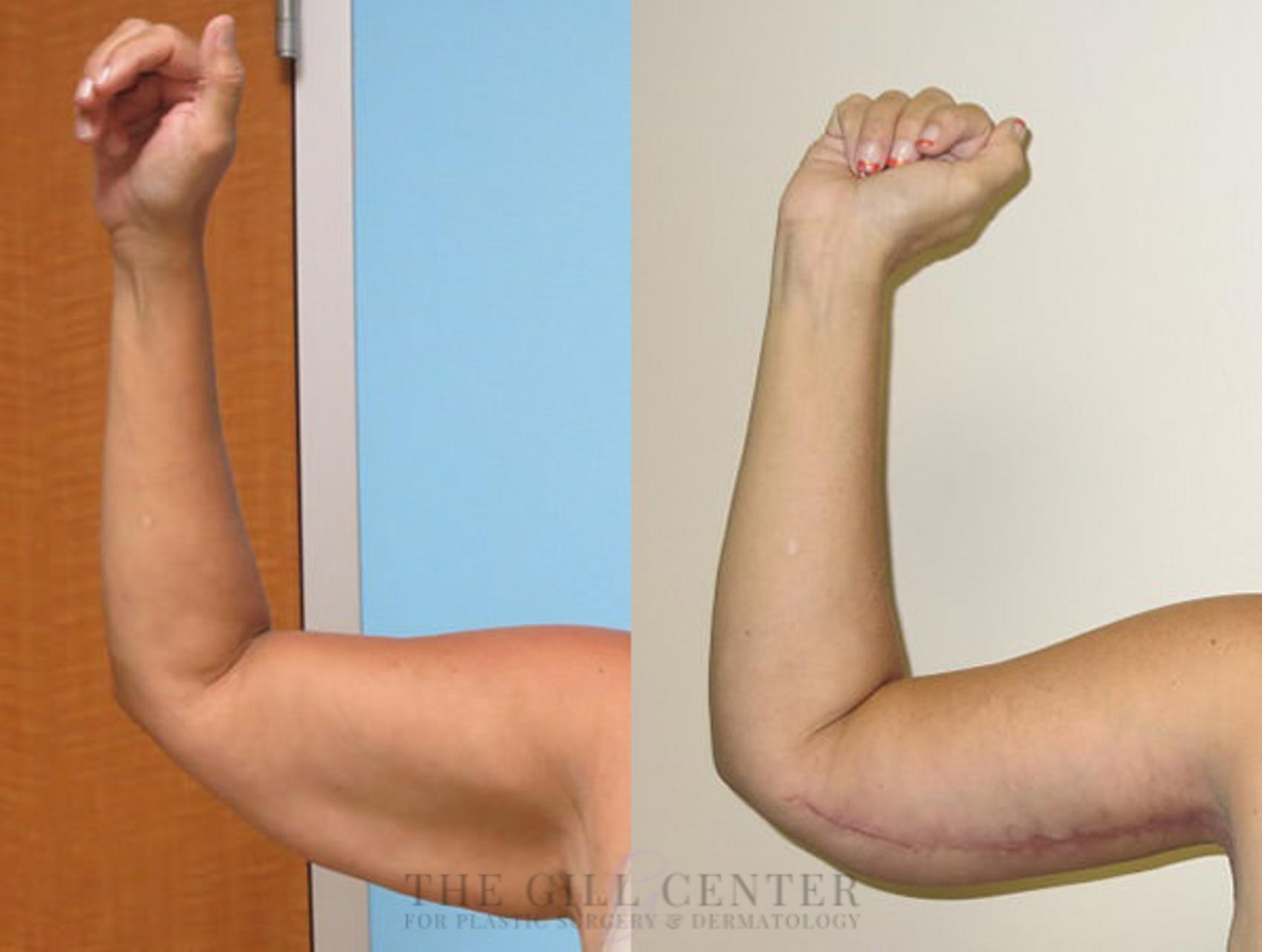 Arm Lift Case 9 Before & After Front | The Woodlands, TX | The Gill Center for Plastic Surgery and Dermatology